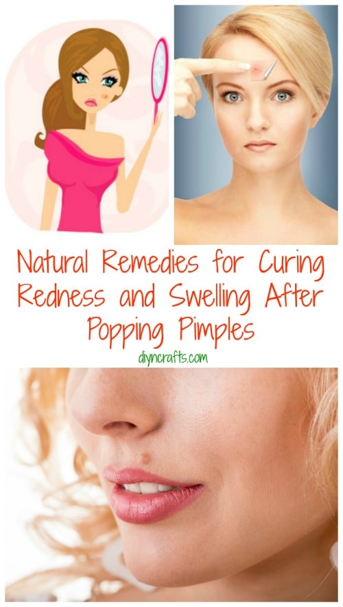 Natural Remedies for Curing Redness and Swelling After Popping Pimples