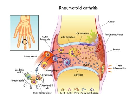 6. Arthritis