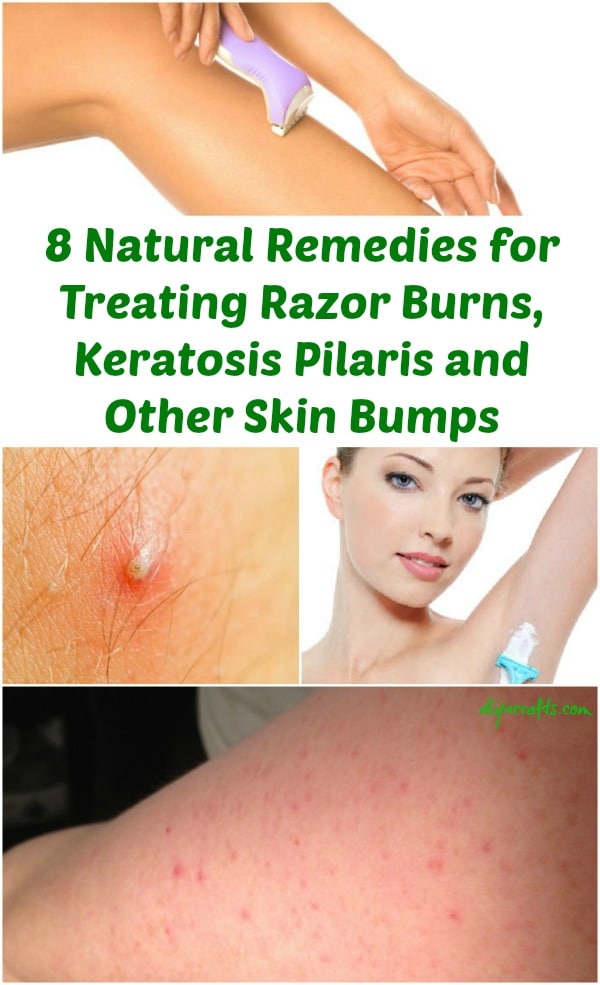 8 Natural Remedies for Treating Razor Burns, Keratosis Pilaris and Other Skin Bumps