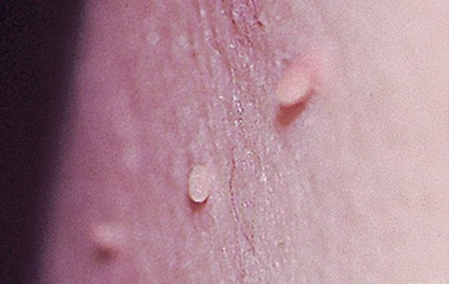 20. Remove Warts and Skin Tags