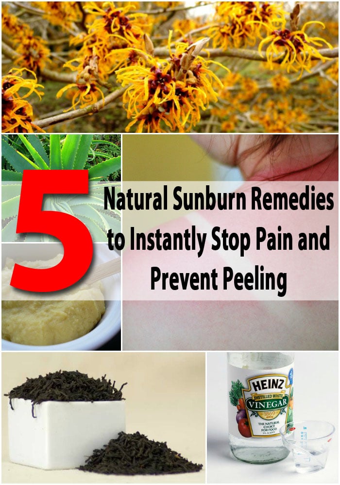 5 Natural Sunburn Remedies to Instantly Stop Pain and Prevent