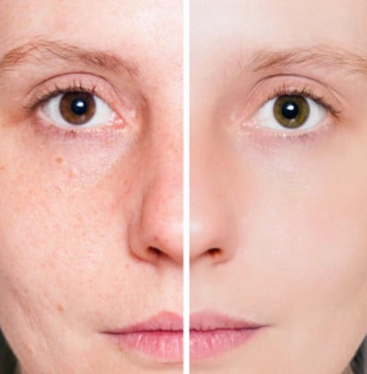 Acne cleaning - before and after