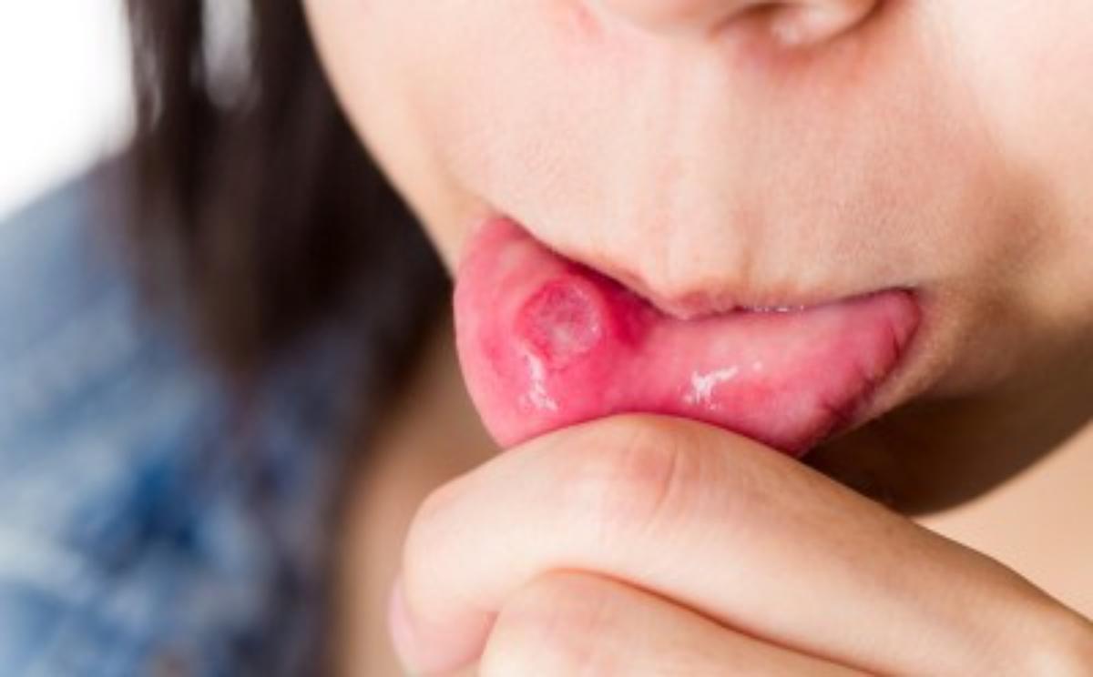 Canker sores in mouth