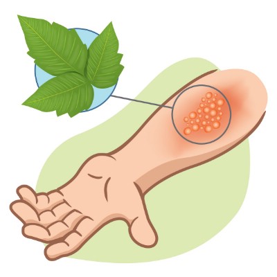 Relieve poison ivy and poison oak.