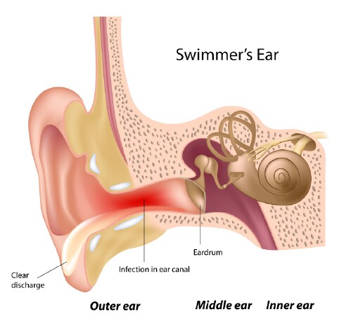 Prevent swimmer’s ear.