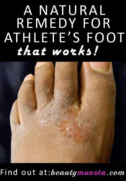 Natural Athlete’s Foot Remedy
