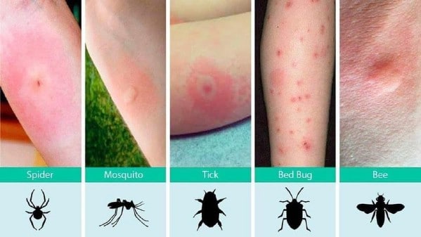 Bug bite infographic